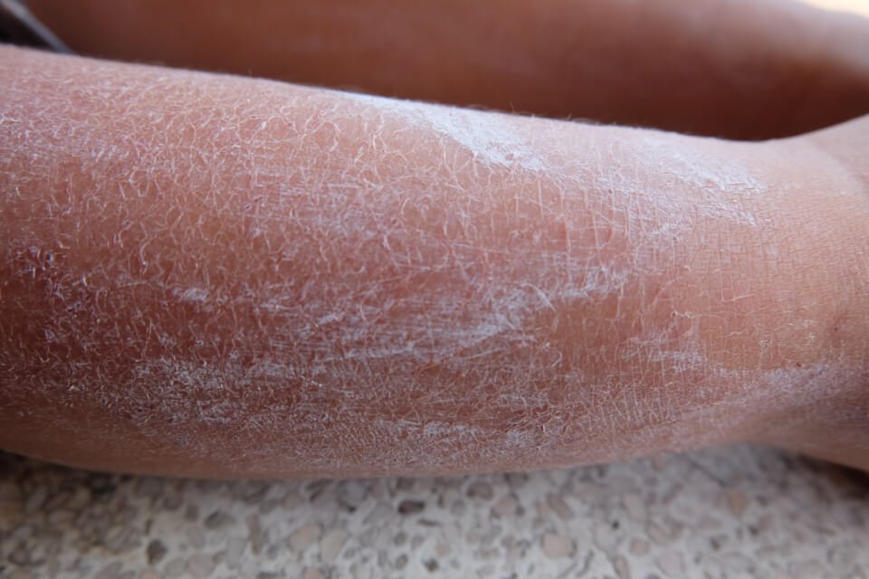 Dry Skin Problem 3